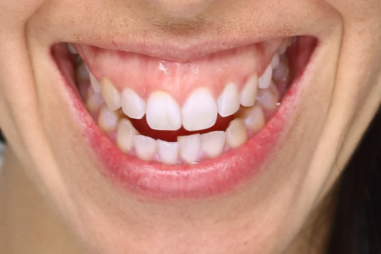 Gum Depigmentation